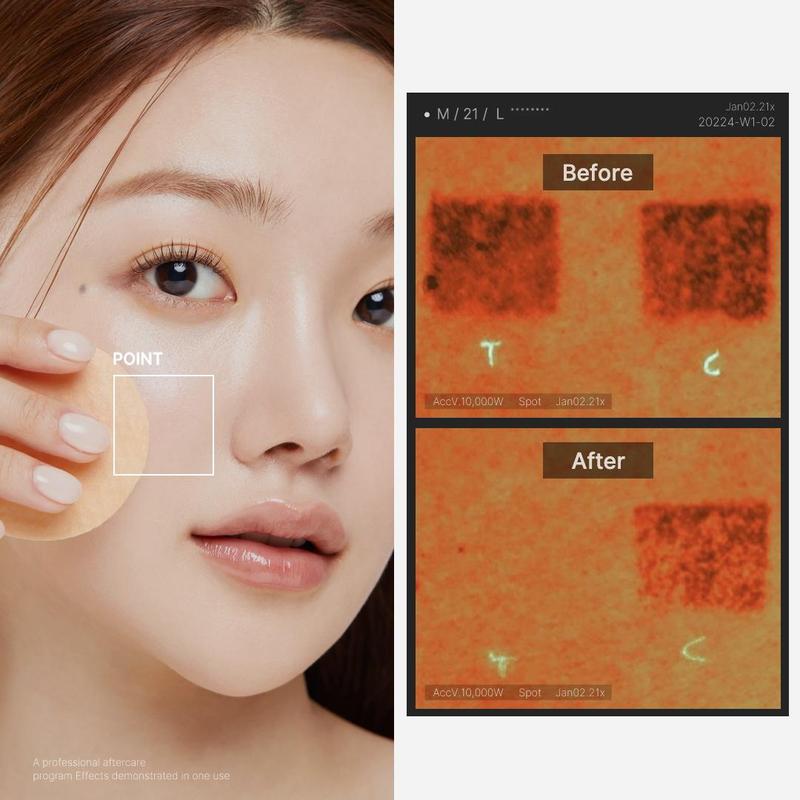 Viral Red Pads | For hormonal Acne