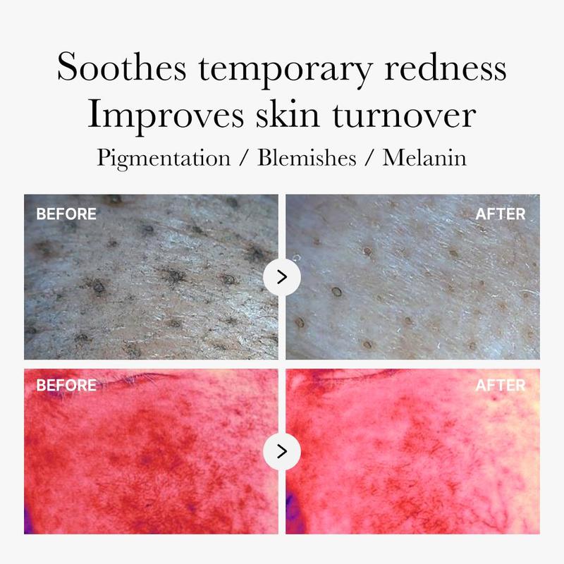 Viral Red Pads | For hormonal Acne
